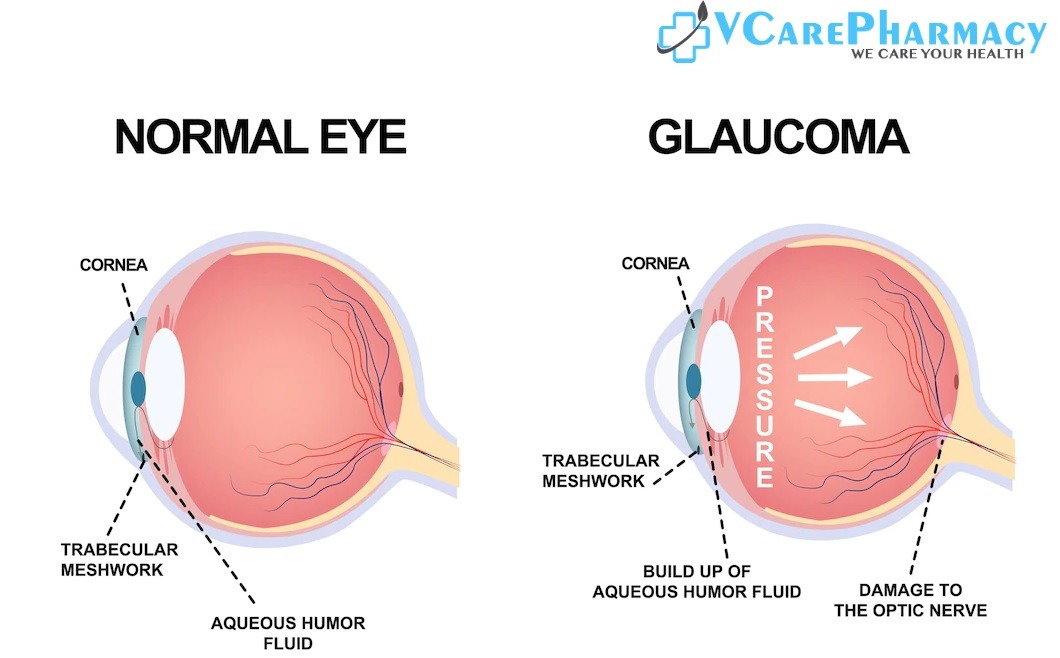 Ketorolac 10 mg Tablet Side Effects if you Have Glaucoma 